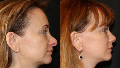 Rinoplastica prima e dopo