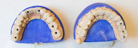 Modello di denti artificiali