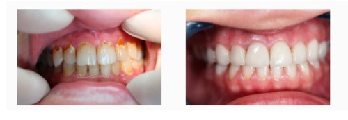 Faccette installate nella Dental Dynastia 